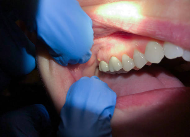 Best Emergency Dental Extractions in Highspire, PA